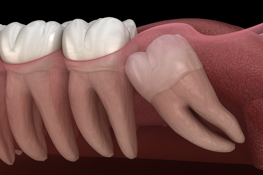 Dental Implants in Waltham